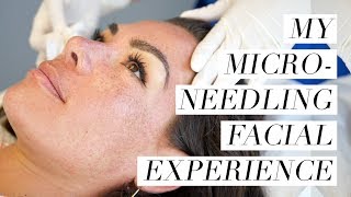 My Microneedling Facial Experience [upl. by Longan896]