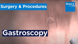 How a gastroscopy is carried out  Bupa Health [upl. by Adolph]