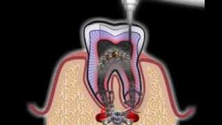 Wurzelbehandlung beim Zahnarzt [upl. by Erodeht126]