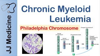 Chronic Myeloid Leukemia CML  Pathogenesis Symptoms and Treatment [upl. by Laefar]