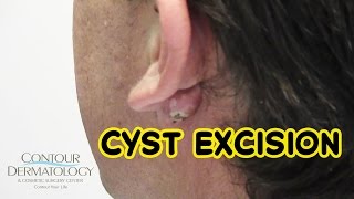 Stubborn Reoccurring Cyst Needs Removal [upl. by Gilbert]