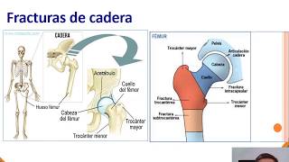 fracturas de cadera [upl. by Yrkcaz]