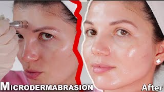 MICRODERMABRASION at home 2021 skin expert FULL procedure and before and after results [upl. by Amias]