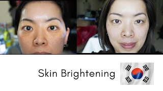 Skin Whitening in Korea  Seoul Guide Medical [upl. by Mallon843]